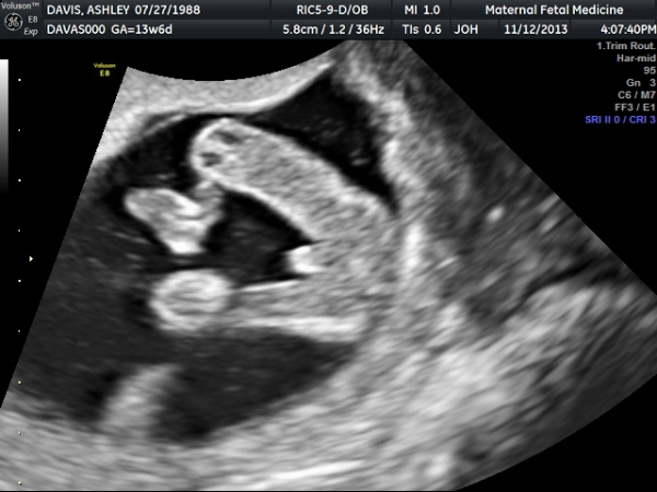 14 Week Ultrasound - GENDER REVEAL! - Bs and Babies